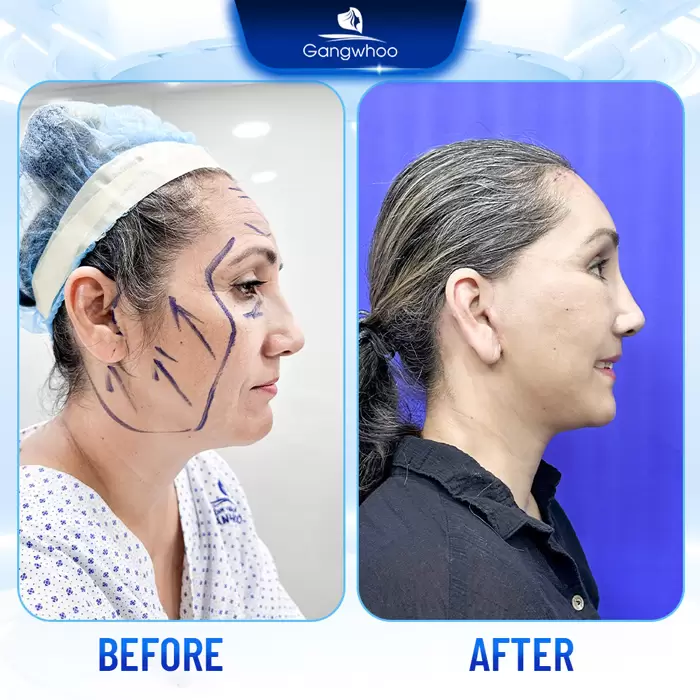 Firin Nano Collagen: A Revolutionary Facelift Technique with Thread Rejuvenation 3 cang da mat bang chi en 5