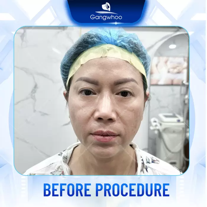 Firin Nano Collagen: A Revolutionary Facelift Technique with Thread Rejuvenation 8 cang da mat bang chi en 6