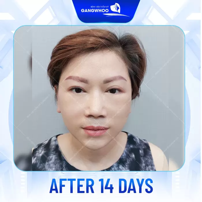 Firin Nano Collagen: A Revolutionary Facelift Technique with Thread Rejuvenation 9 cang da mat bang chi en 8
