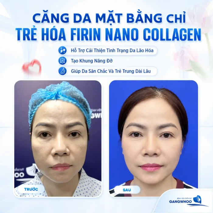 Căng Da Mặt Bằng Chỉ Trẻ Hóa Firin Nano Collagen Hiệu Quả Toàn Diện