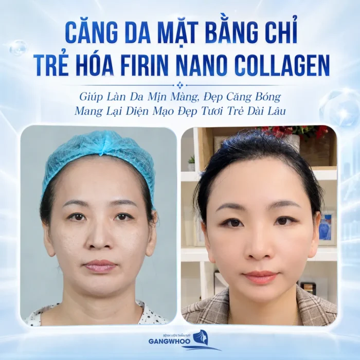 Căng Da Mặt Bằng Chỉ Trẻ Hóa Firin Nano Collagen Hiệu Quả Toàn Diện