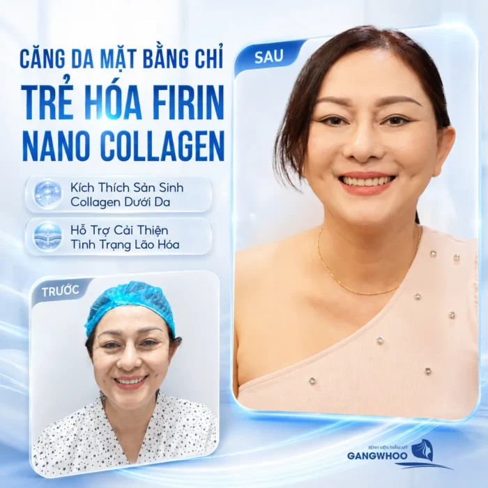 Căng Da Mặt Bằng Chỉ Trẻ Hóa Firin Nano Collagen Hiệu Quả Toàn Diện