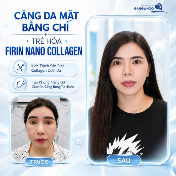 Căng Da Mặt Bằng Chỉ Trẻ Hóa Firin Nano Collagen Hiệu Quả Toàn Diện