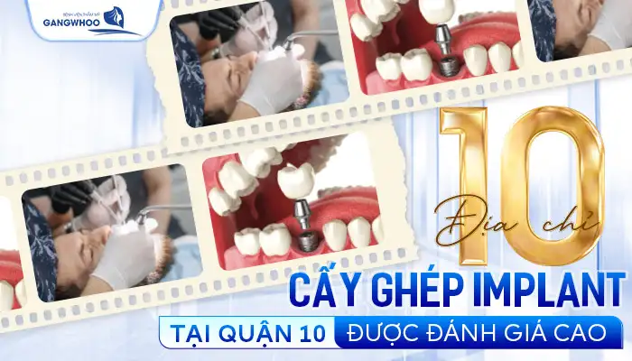 cay ghep implant ta quan 10