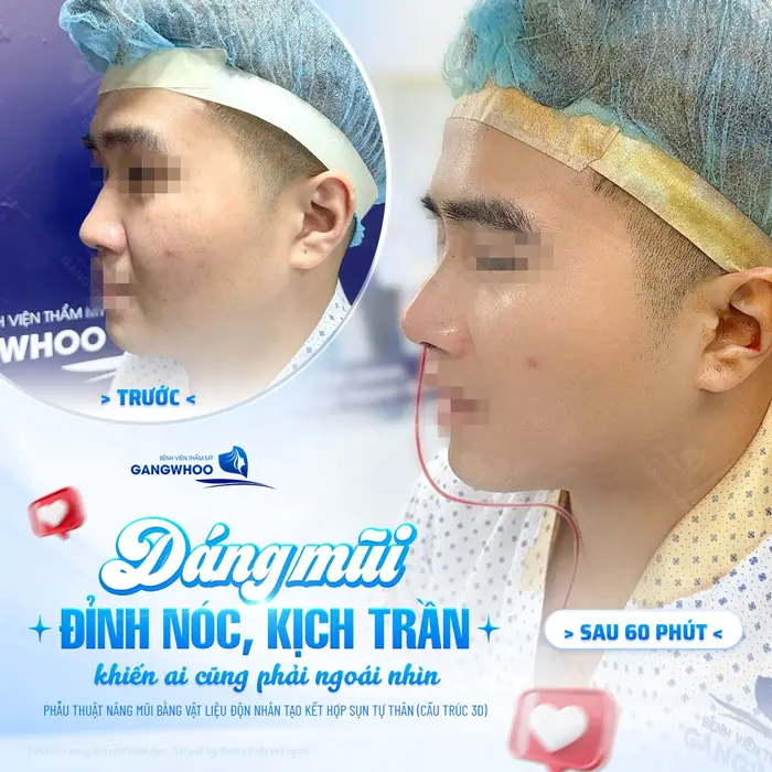 Dáng mũi mới gương mặt mới sau ngay phẫu thuật đã thay đổi và lột xác đến khó tin 