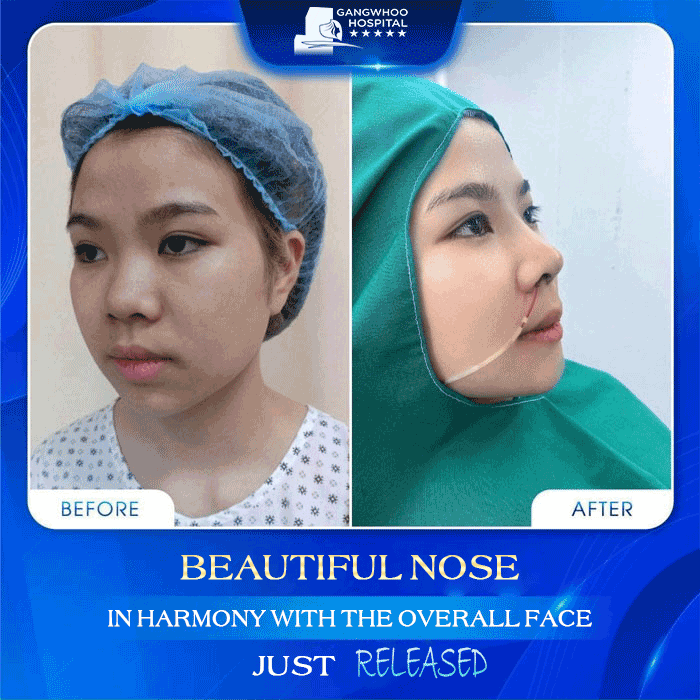 advantages of Artificial Cartilage Rhinoplasty