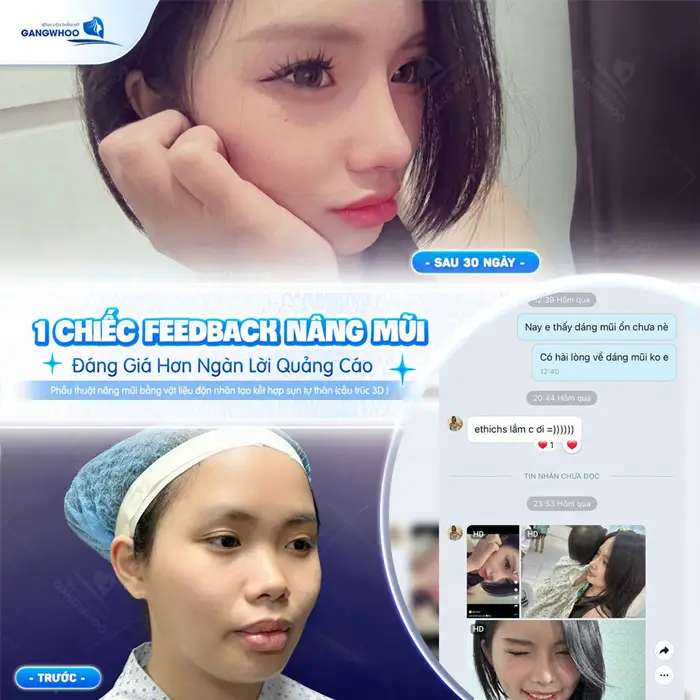 Sự Thật Về Nâng Mũi Sụn Sinh Học Hàn Quốc 6 1 chiếc Feedback đáng giá hơn ngàn lời quảng cáo sau 30 ngày nhan sắc thăng hạng đầy rạng rỡ