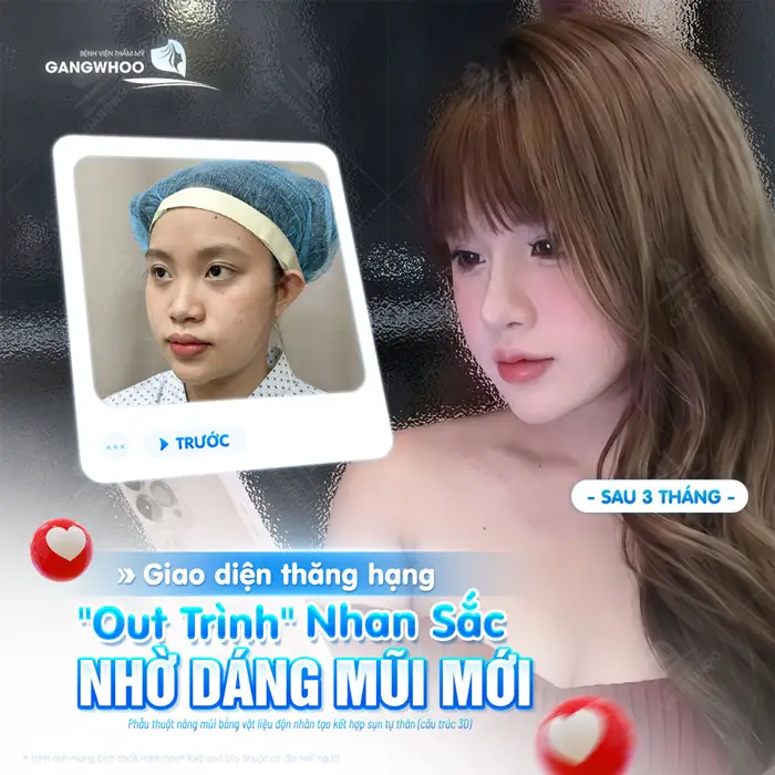 Giao diện thăng hạng nhan sắc thăng hoa nhờ dáng mũi mới cao đẹp, hài hòa và mềm mại