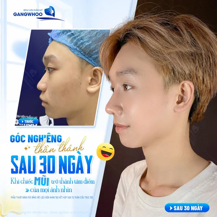 Góc nghiêng thần thai sau 30 ngày chiếc mũi vào form đẹp chuẩn trên cả mong đợi 
