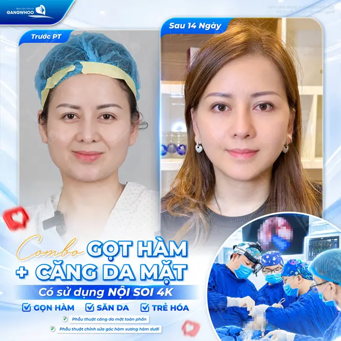 Thực hiện combo gọt hàm kết hợp căng da mặt gương mặt hài hòa, đường nét thanh thoát ngay sau phẫu thuật