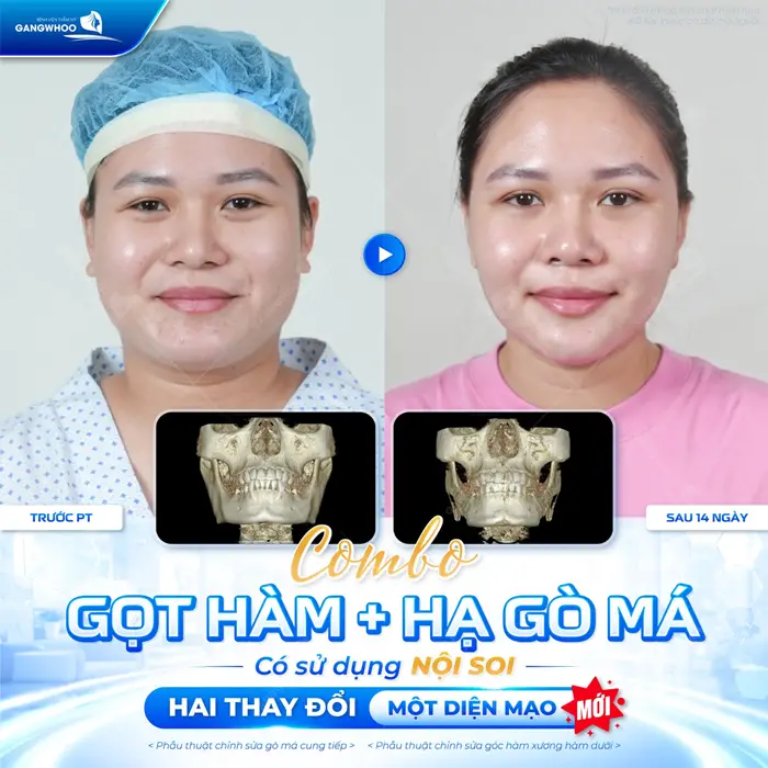 Gọt Hàm Có Đau Không? Gọt Hàm Có Ảnh Hưởng Về Sau Không? 2 Thực hiện combo gọt hàm và hạ gò má tại Gangwhoo 1 sự lột xác diện mạo đầy xứng đáng