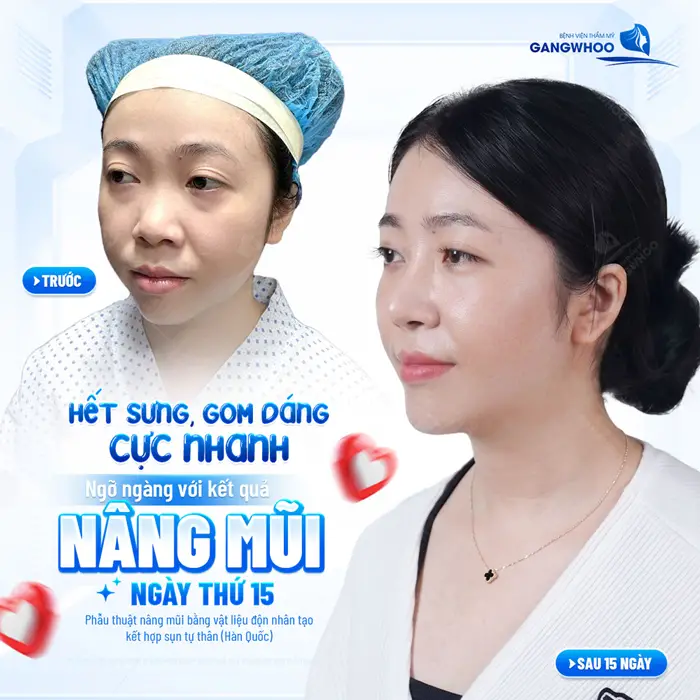 Nâng Mũi Bọc Sụn Vành Tai Kèm Bọc AlloDerm Và Những Điều Cần Biết 3 Nâng mũi ngày thứ 15 mũi đẹp cao sang diện mạo thêm sáng