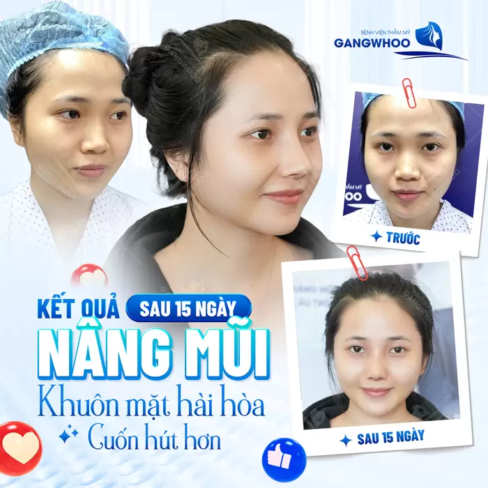 Kết quả sau 15 ngày nâng mũi sở hữu khuôn mặt hài hòa và cuốn hút hơn