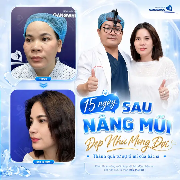 Nâng Mũi Sụn Hàn Quốc Kèm Bọc Sụn Vành Tai - An Toàn, Chuẩn S Line 1 15 ngày sau nâng mũi đẹp như mong đợi thành quả từ sự tỉ mỉ của bác sĩ