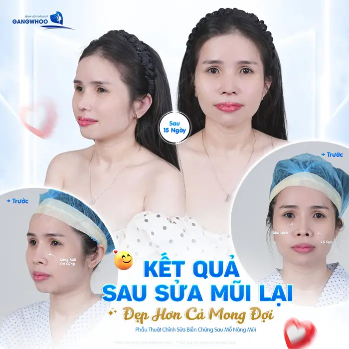4 Dấu Hiệu Nâng Mũi Bọc Sụn Bị Hỏng: Nguyên Nhân & Cách Khắc Phục 3 Kết quả sau sửa mũi lại đẹp hơn cả mong đợi diện mạo ngày càng rạng rỡ và tự tin