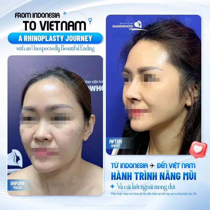 Khách quốc tế lựa chọn nâng mũi tại Gangwhoo và cái kết đẹp ngoài mong đợi 