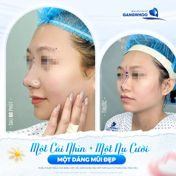Sự Thật Về Nâng Mũi Sụn Sinh Học Hàn Quốc 5 Hoàn thiện 1 dáng mũi gương mặt thêm bừng sức sống với diện mạo thêm cuốn hút sau 60 phút vừa hoàn thành