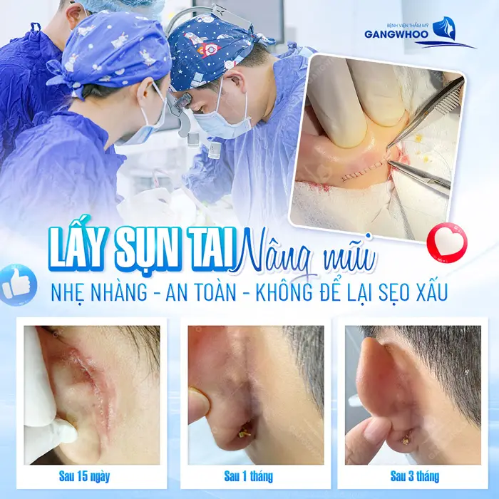 Lấy sụn tai nâng mũi nhẹ nhàng, an toàn và không để lại sẹo xấu 