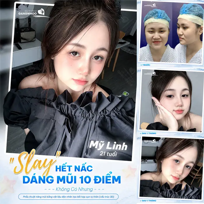 Nâng Mũi Cấu Trúc Và Nâng Mũi Bọc Sụn: Ưu Và Nhược Điểm 1 Dáng mũi cao đẹp 10 điểm nhan sắc thêm thăng hạng và có điểm nhấn tôn lên đường nét quyến rũ cho khuôn mặt