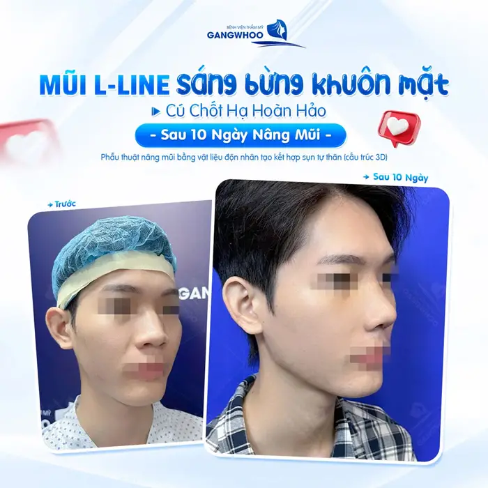 Nâng Mũi Bọc Sụn Có Đẹp Không? 3 Lưu Ý Dáng Mũi Đẹp 3 Mũi L Line bừng sáng khuôn mặt chốt hạ diện mạo hoàn hảo sự lột xác hoàn toàn sau 10 ngày phẫu thuật