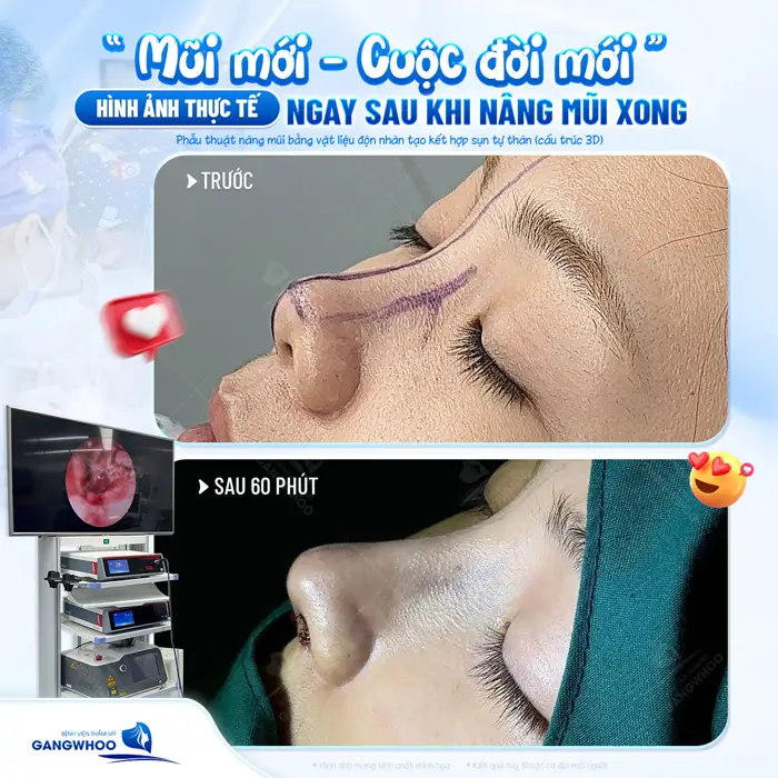 Mũi mới và cuộc đời mới hình ảnh thực tế ngay sau khi vừa can thiệp phẫu thuật