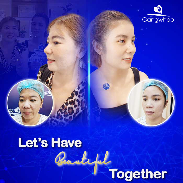 Ear cartilage Rhinoplasty Good or Not? Experts Explain