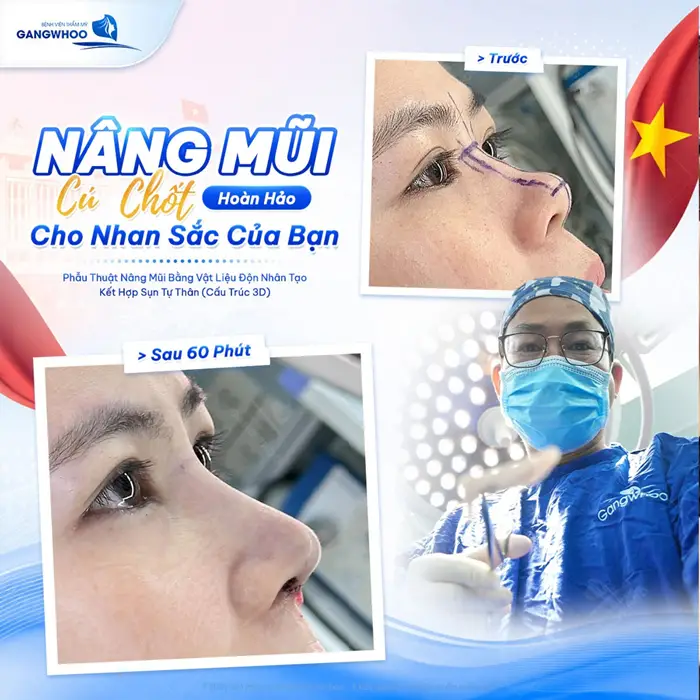 Sau 60 phút nâng mũi nhan sắc thay đổi đầy ngoạn mục nhan sắc thang hạng hơn ngay sau ca phẫu thuật