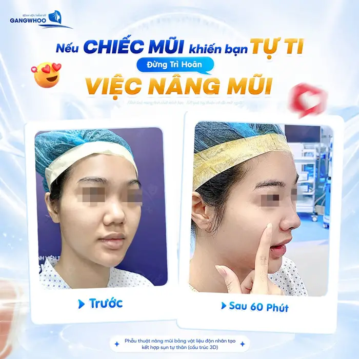 Sự Thật Về Nâng Mũi Sụn Sinh Học Hàn Quốc 4 Dáng mũi cao đẹp đầy xuất sắc sau 60 phút nhan sắc đã thăng hạng với đường nét ấn tượng hơn