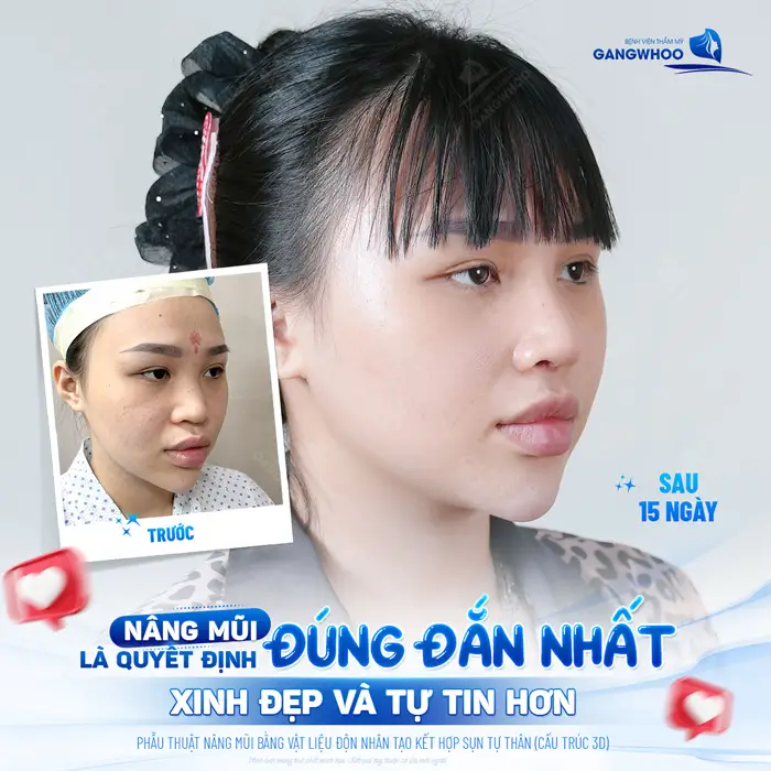 Nâng mũi tại địa chỉ uy tín là quyết định đúng đắn cho 1 diện mạo xinh đẹp và tự tin hơn 