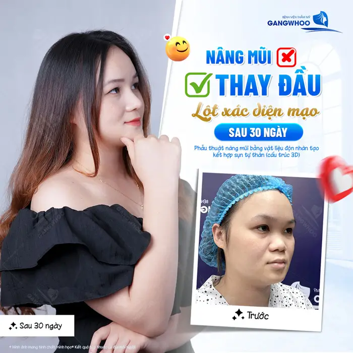 Nâng Mũi Bọc Sụn Vành Tai Kèm Bọc AlloDerm Và Những Điều Cần Biết 2 Nâng mũi thay đổi diện mạo sau 30 ngày đã hoàn toàn thăng hạng diện mạo ngày càng cuốn hút và tự tin