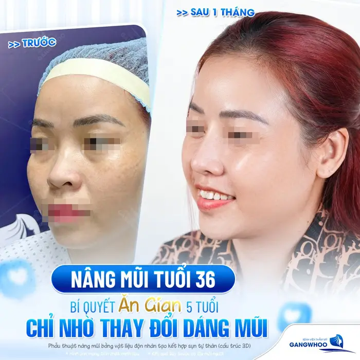 Nâng mũi ở tuổi 36 bí quyết ăn gian 5 tuổi chỉ nhờ thay đổi nhỏ ở phần mũi