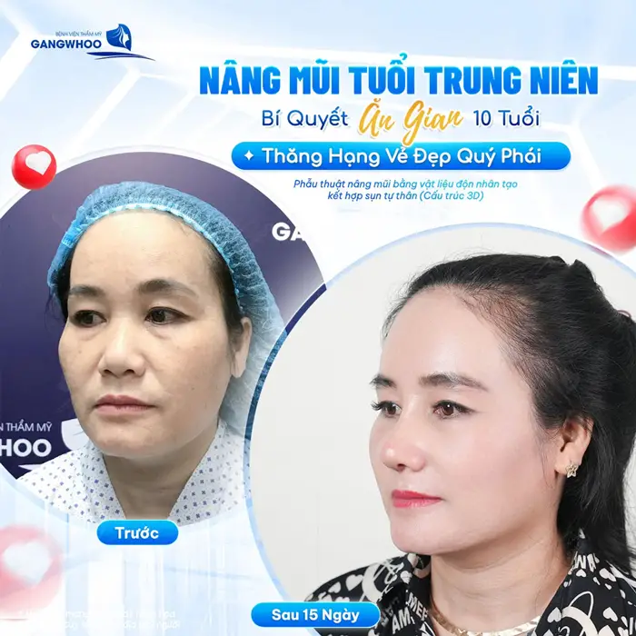 Nâng mũi tuổi trung niên bí quyết ăn gian 10 tuổi thăng hạng vẻ đẹp cho diện mạo thêm quý phái 