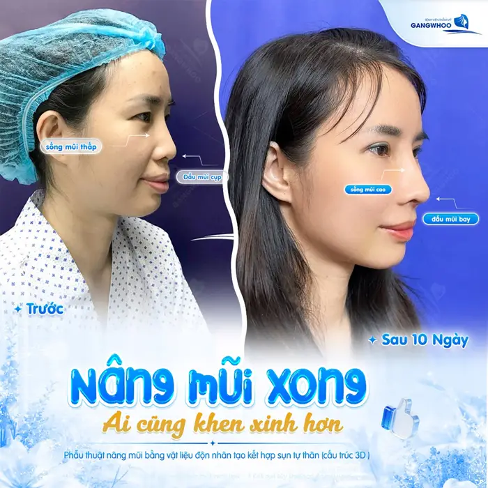 Nâng Mũi Bọc Sụn Megaderm Bao Nhiêu Tiền? Có Đắt Không? 1 Nâng mũi xong ai cũng khen vì diện mạo xinh đẹp và có điểm nhấn hơn sau ca phẫu thuật