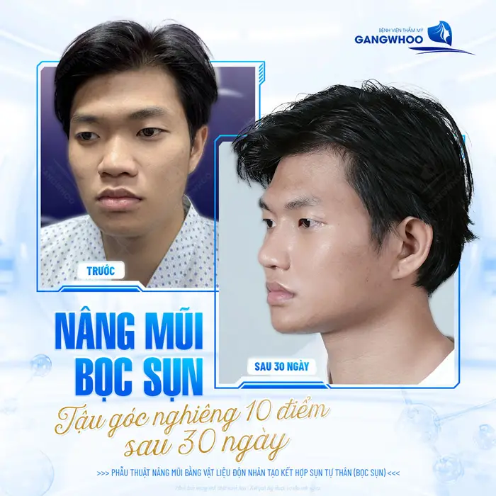 Nâng mũi bọc sụn tậu góc nghiêng 10 điểm sau 30 ngày thực hiện 