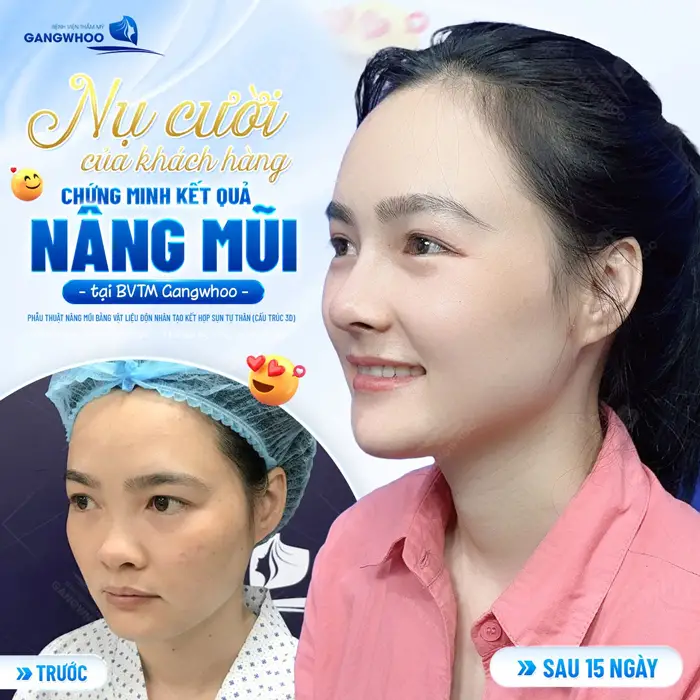 Nụ cười của khách hàng minh chứng cho kết quả nâng mũi bền đẹp và an toàn tại bệnh viện thẩm mỹ Gangwhoo 