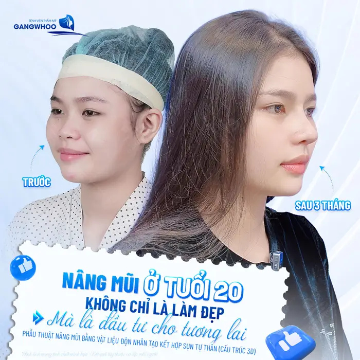 Phẫu thuật nâng mũi bằng vật liệu nhân tạo kết hợp sụn tự thân mũi cao đẹp, hài hòa và tự nhiên