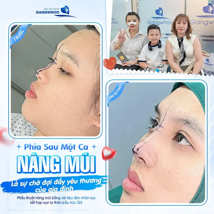 Nâng Mũi Hàn Quốc Có Vĩnh Viễn Không? Bác Sĩ Giải Đáp 5 Phía sau 1 ca nâng mũi là sự chờ đợi đầy yêu thương của gia đình