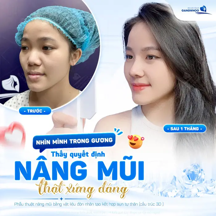 Sau 1 tháng nâng mũi diện mạo đẹp xuất sắc và thêm điểm nhấn rạng rỡ, đẹp chuẩn tỷ lệ