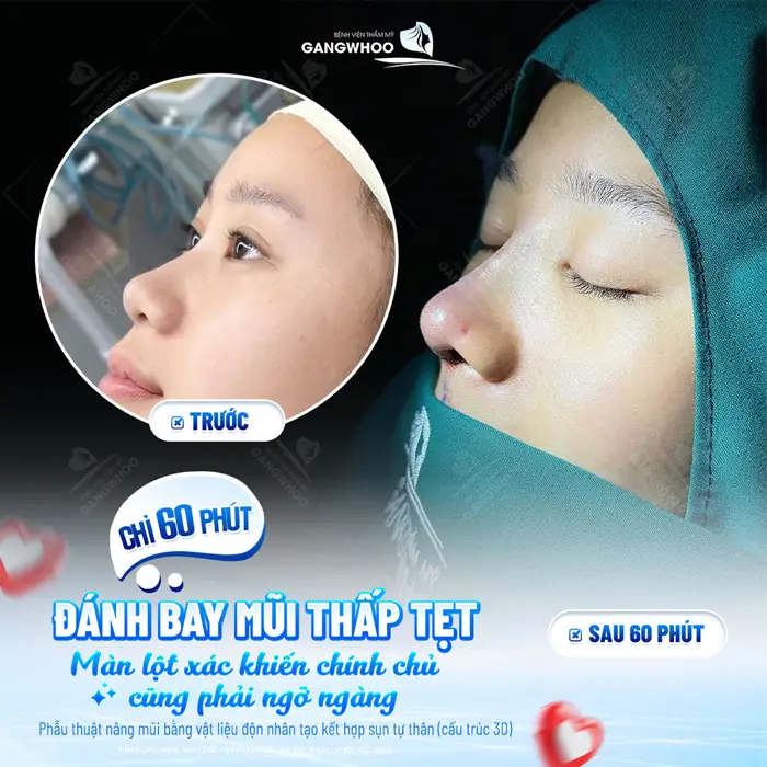Nâng Mũi Bọc Sụn Vành Tai Kèm Bọc AlloDerm Và Những Điều Cần Biết 1 Đánh bay mũi thấp lột xác mũi đẹp đến ngỡ ngàng sau 60 phút góc nghiêng đã cao đẹp xuất sắc