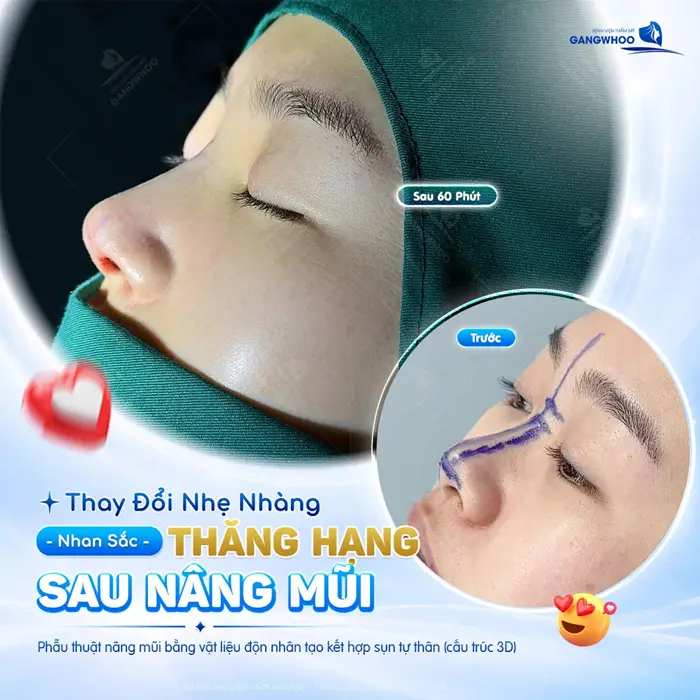 Top 5 Bác Sĩ Nâng Mũi Hàn Quốc chuyên môn cao Tại TPHCM 1 Thay đổi nhẹ nhàng nhan sắc thăng hạng sau nâng mũi