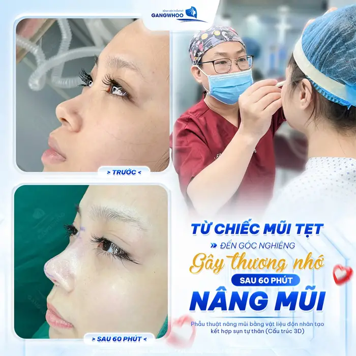 Từ chiếc mũi tẹt đến góc nghiêng gây thương nhớ sau 60 phút nâng mũi tại Gangwhoo