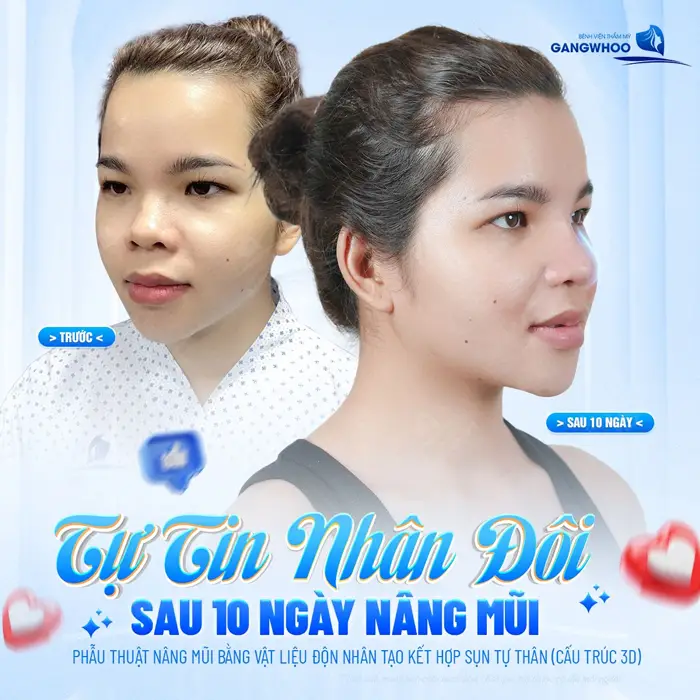 Tự tin nhân đôi sau 10 ngay can thiệp phẫu thuật nâng mũi ứng dụng công nghệ hiện đại tại BVTM Gangwhoo