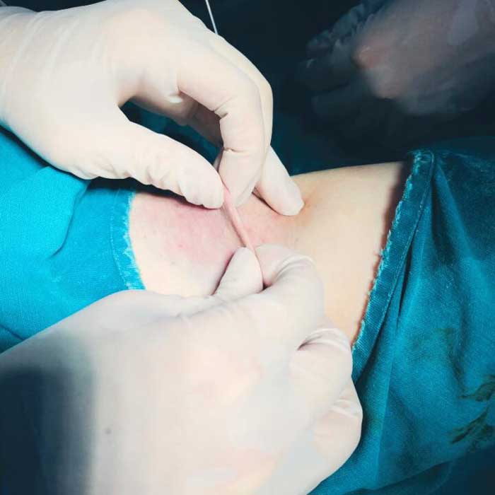 Điều trị hôi nách phẫu thuật an toàn không để lại sẹo tại BVTM Gangwhoo
