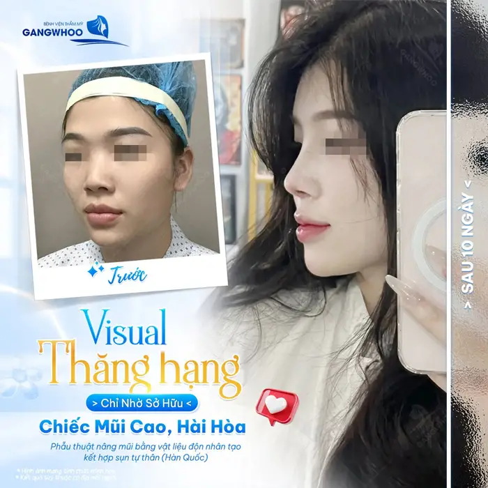 Visual thăng hạng chỉ nhờ 1 chiếc mũi cao hài hòa lựa chọn sáng suốt sau nâng mũi