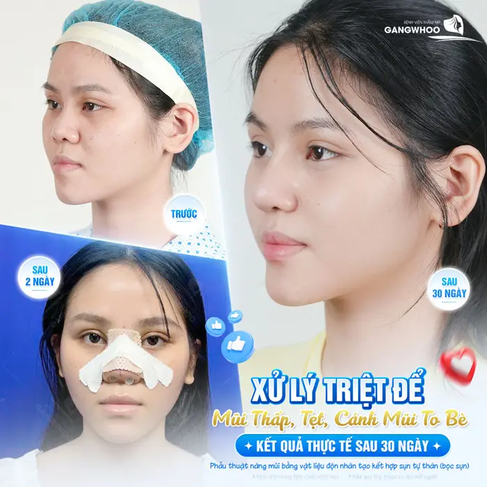 Xử lý triệt dể mũi thấp tẹt, cánh mũi to bè kết quả sau 30 phút đã rạng rỡ diện mạo 