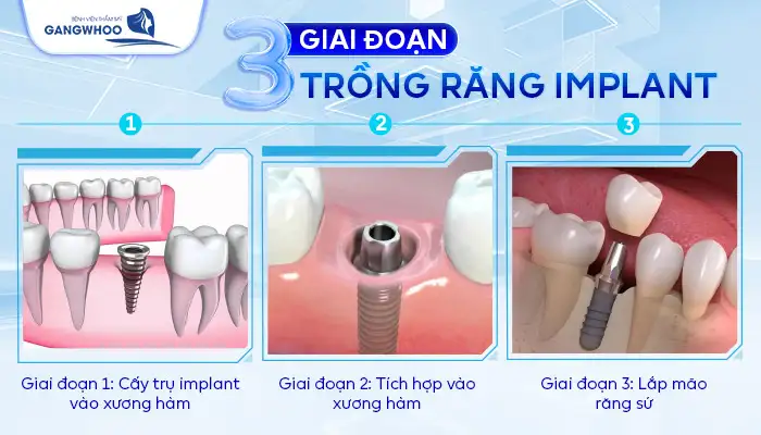 Cấy Ghép Implant Răng Cửa Có Đau Không? Giá Bao Nhiêu 3 Cấy Ghép Implant Răng Cửa