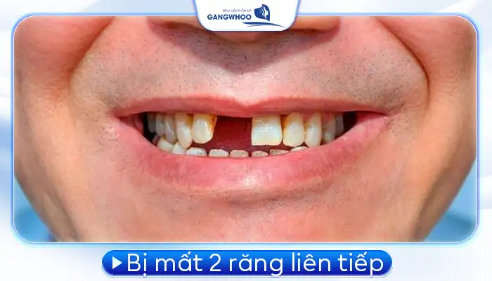 Các Trường Hợp Nên Cấy Ghép Implant Bác Sĩ Chỉ Định 5 Các Trường Hợp Nên Cấy Ghép Implant
