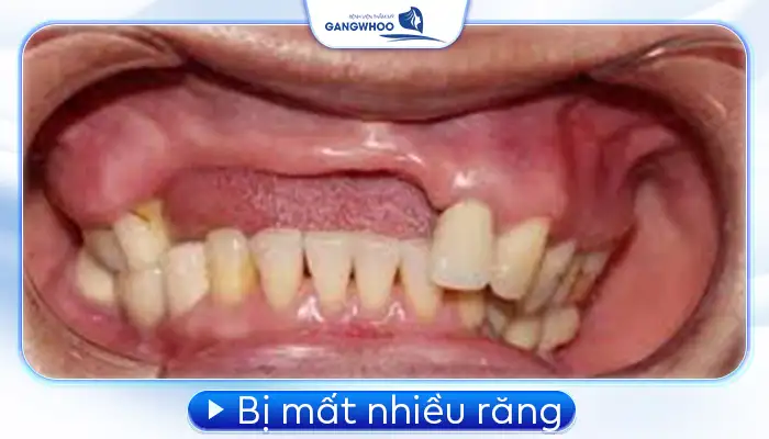 Các Trường Hợp Nên Cấy Ghép Implant Bác Sĩ Chỉ Định 6 Các Trường Hợp Nên Cấy Ghép Implant