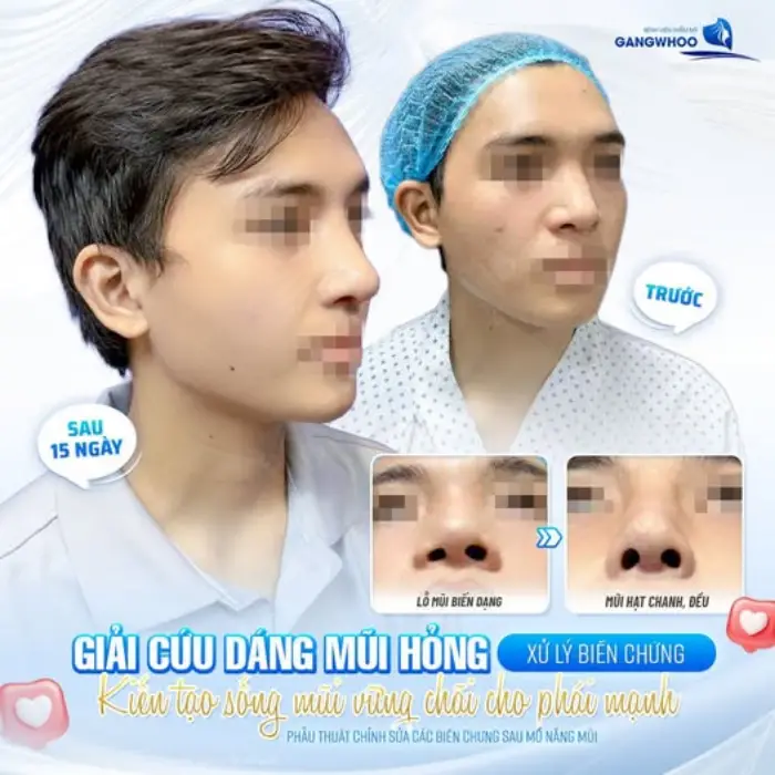 Phẫu thuật sửa lại mũi bằng kỹ thuật nâng mũi cấu trúc Phục hồi dáng mũi tự nhiên, an toàn và bền vững