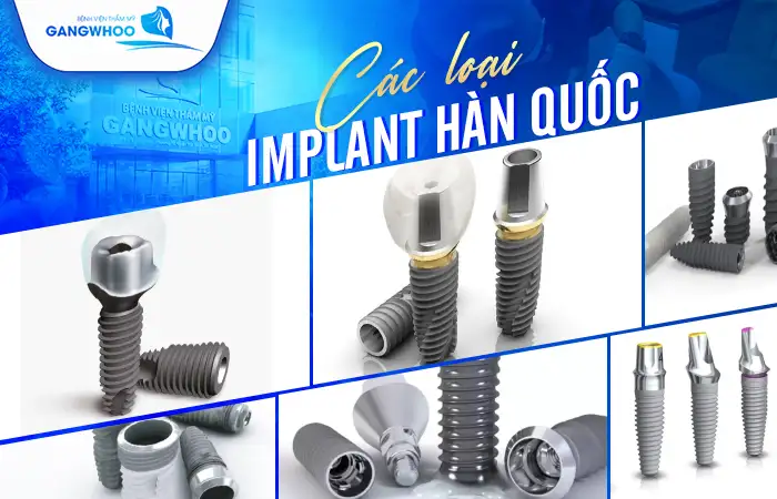 Cấy Ghép Implant Hàn Quốc Có Tốt Không? 6 Loại Trụ Implant 8 Cấy Ghép Implant Hàn Quốc Có Tốt Không